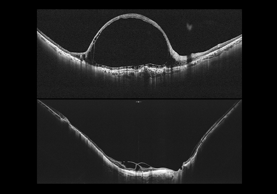 Wide-field Imaging in One Single Capture